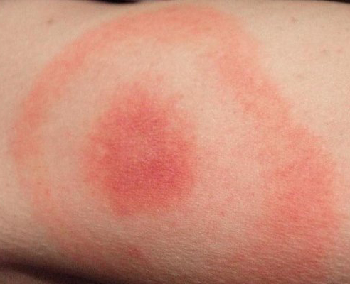 children-lyme-bullseye-rash